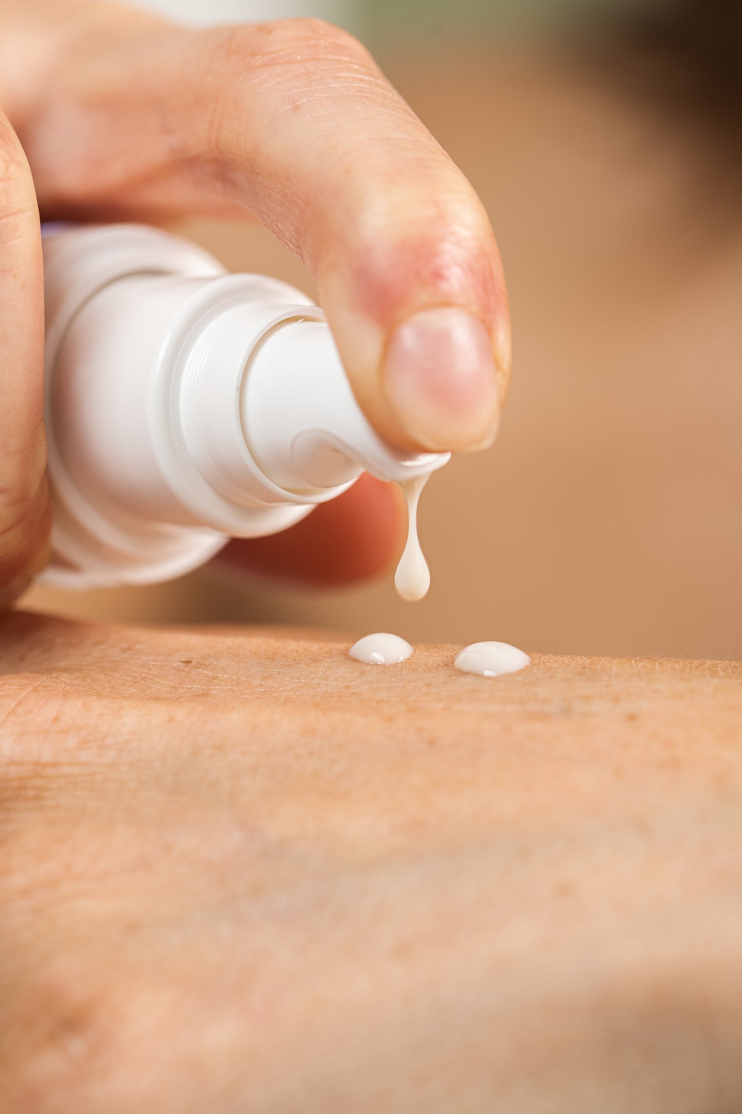 Melasma